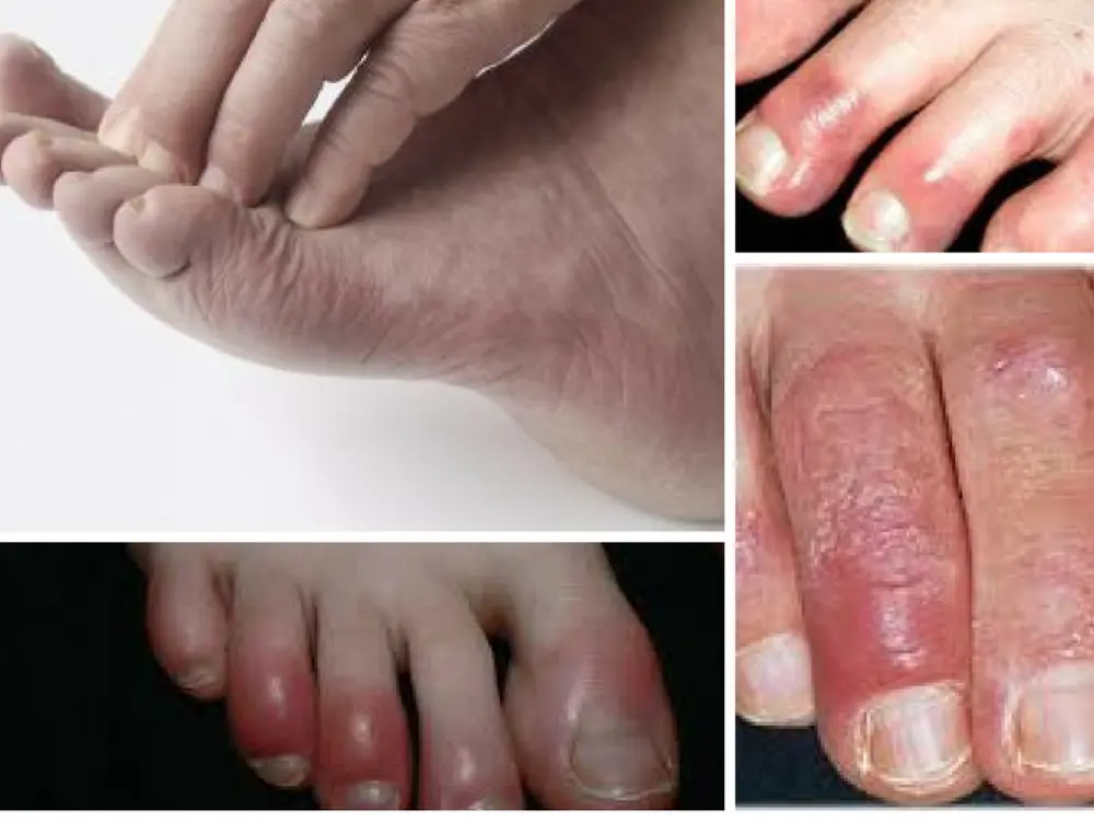 blisters or have cold feet